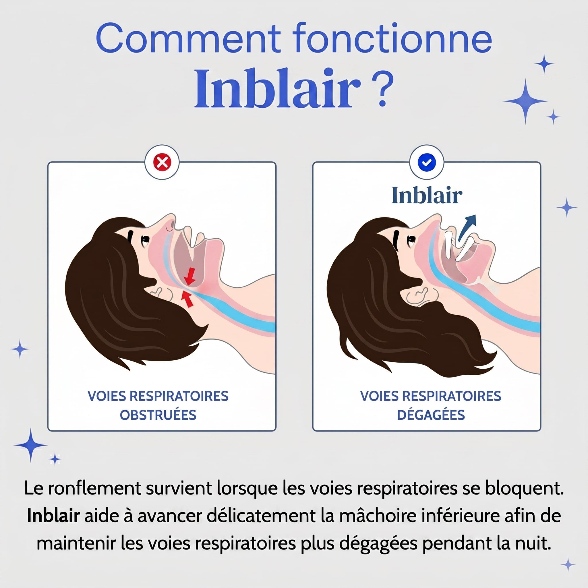 Inblair – Gouttière anti-ronflement ajustable